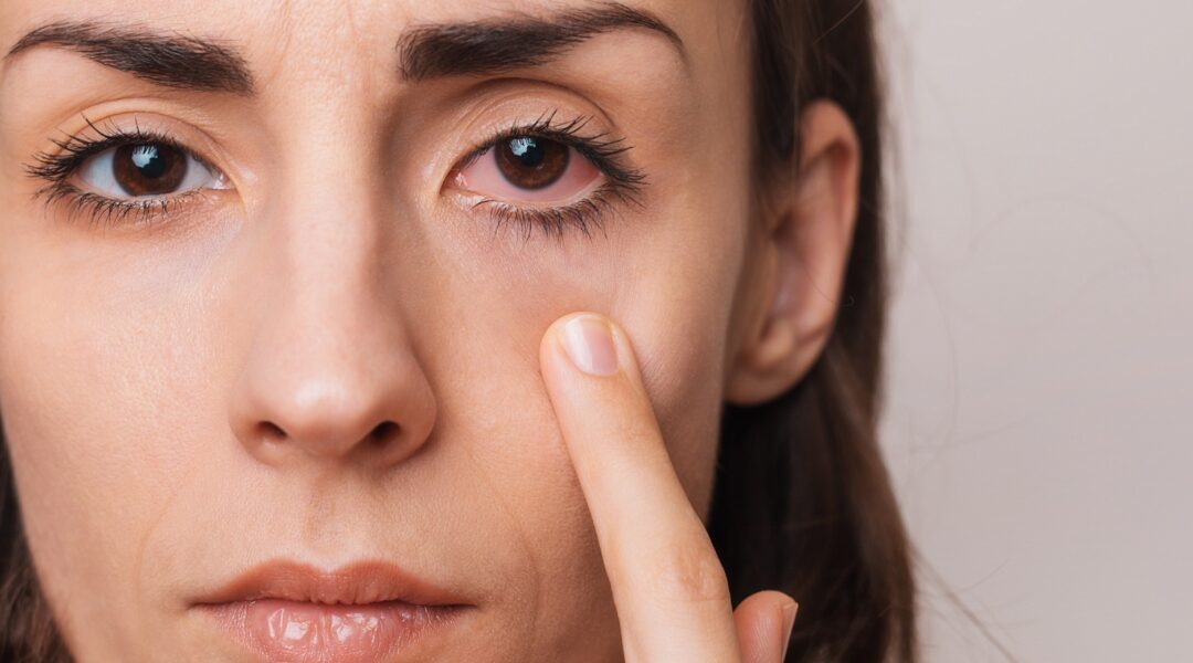 Dry Eye Spa Treatments in St. Louis | Advanced Relief at Erker’s Eyewear