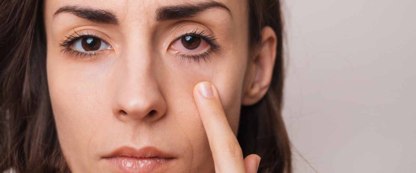 woman-width-red-eyes Woman with red eyes pointing at her right eye